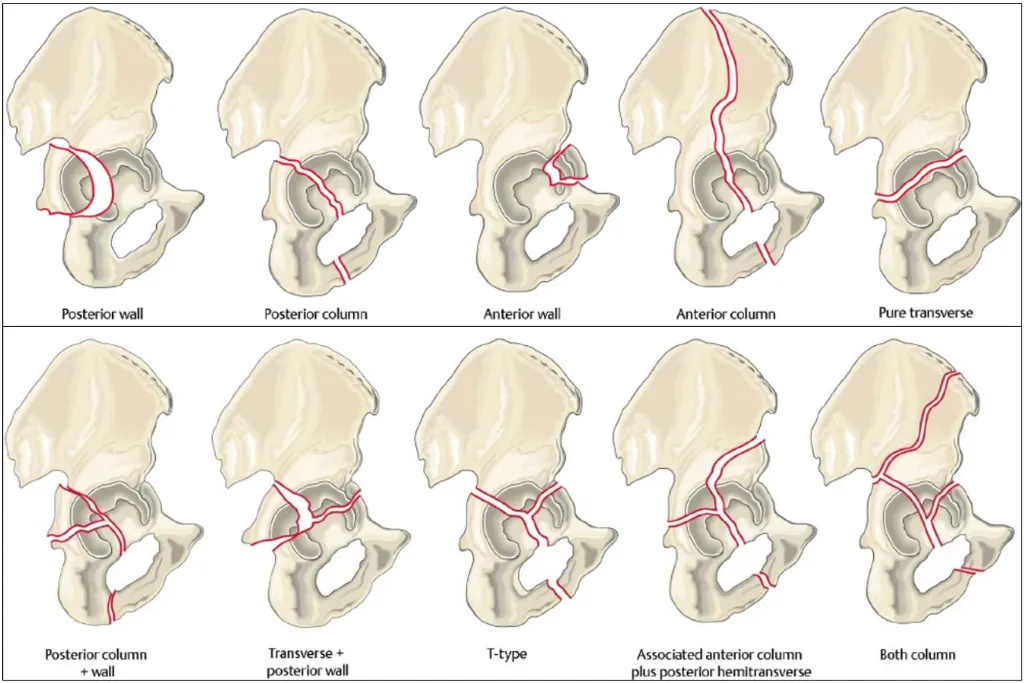 Acetabular Fracture Classification (Letournel & Judet)